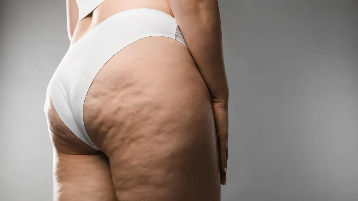A woman in white panties with cellulite on legs and buttocks